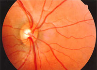 Normal optic nerve