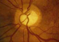 Glaucoma optic nerve