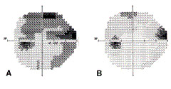Glaucoma visual fields