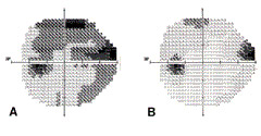 Φωτ.2: Γλαυκωματικά οπτικά πεδία